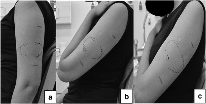 Forensic Bite Mark Analysis: The Science of Impressions in Criminal Investigations